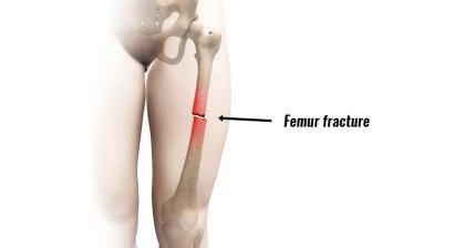femur-fracture800